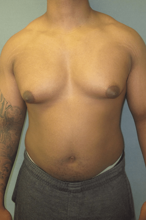 Severe Gynecomastia