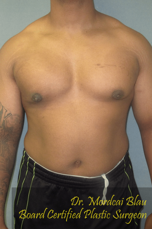 Severe Gynecomastia