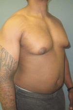 Severe Gynecomastia