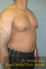 Severe Gynecomastia