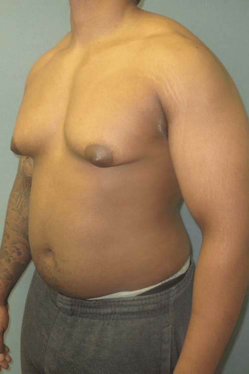 Severe Gynecomastia