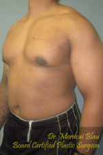 Severe Gynecomastia