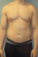 Severe Gynecomastia