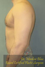 Severe Gynecomastia