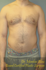 Severe Gynecomastia