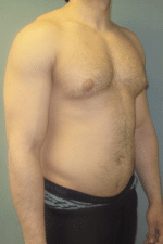 Severe Gynecomastia