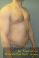 Severe Gynecomastia