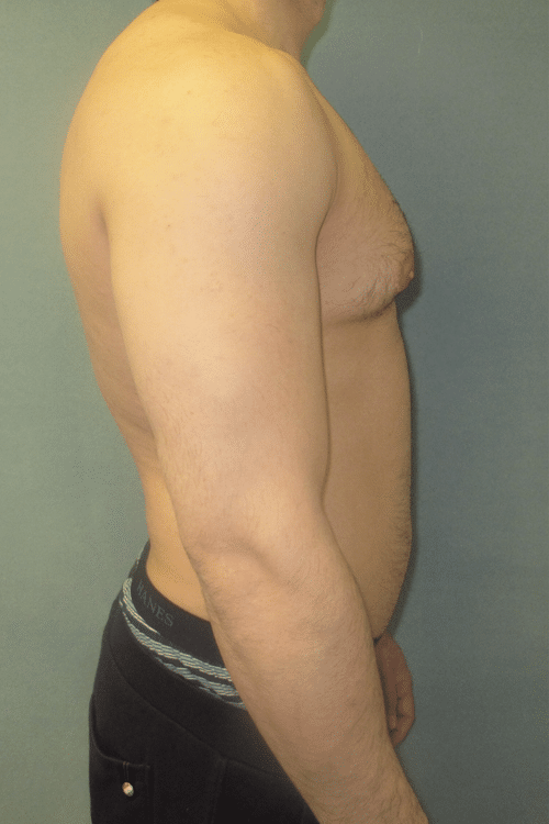 Severe Gynecomastia