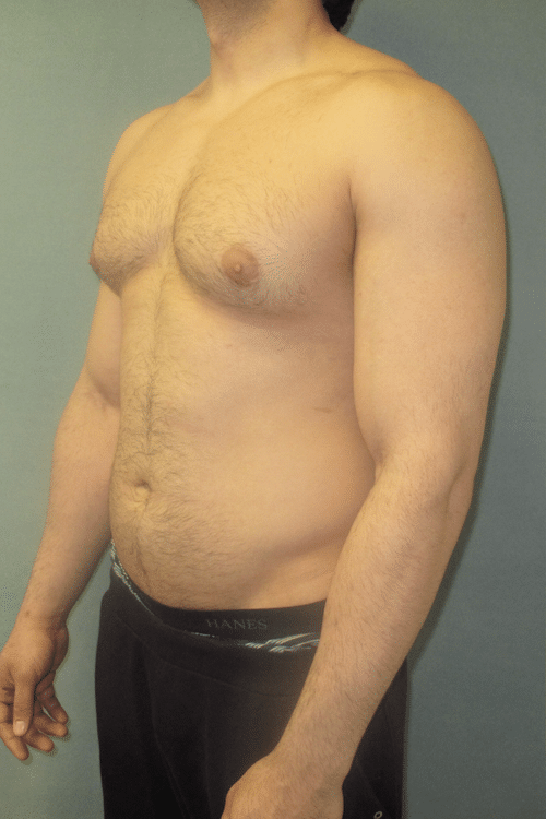 Severe Gynecomastia