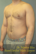 Severe Gynecomastia