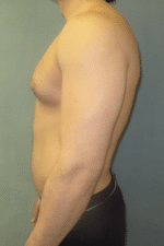 Severe Gynecomastia