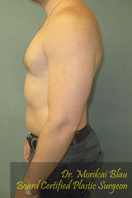 Severe Gynecomastia