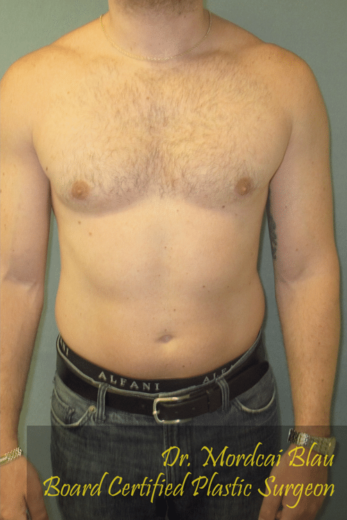 Severe Gynecomastia