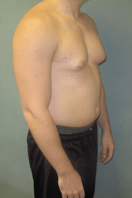 Severe Gynecomastia