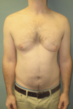 Severe Gynecomastia