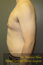 Severe Gynecomastia