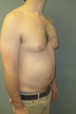 Severe Gynecomastia