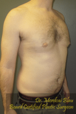 Severe Gynecomastia