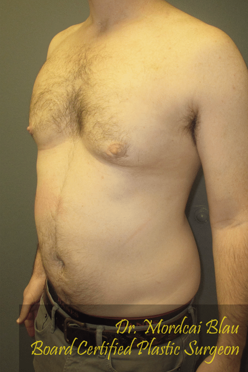 Severe Gynecomastia