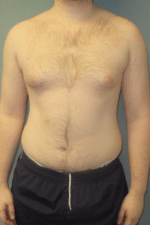 Severe Gynecomastia