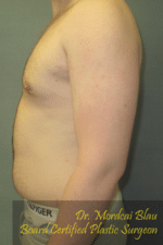 Severe Gynecomastia