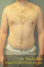 Severe Gynecomastia