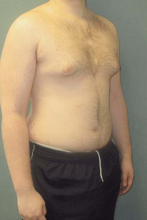 Severe Gynecomastia