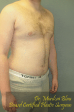 Severe Gynecomastia