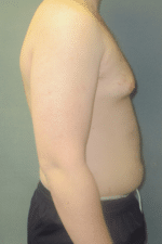 Severe Gynecomastia