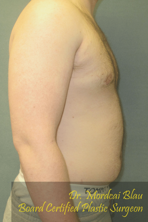 Severe Gynecomastia