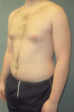 Severe Gynecomastia