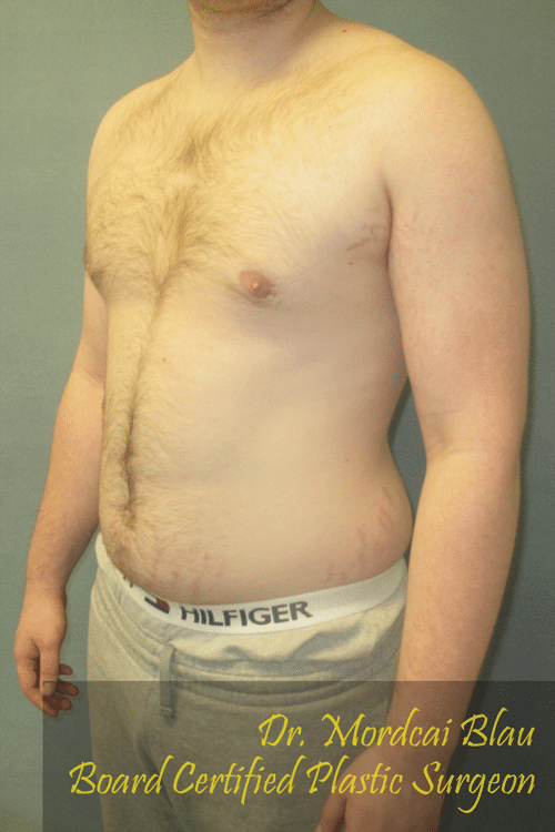 Severe Gynecomastia