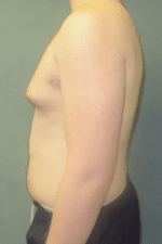 Severe Gynecomastia