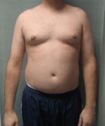 Severe Gynecomastia