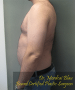 Severe Gynecomastia