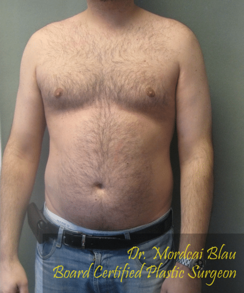 Severe Gynecomastia