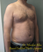 Severe Gynecomastia