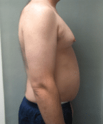 Severe Gynecomastia