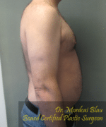 Severe Gynecomastia