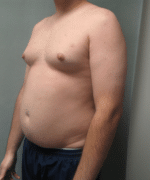 Severe Gynecomastia