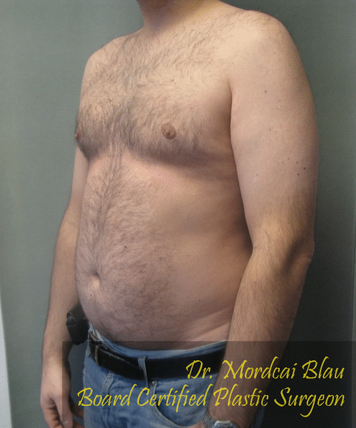 Severe Gynecomastia