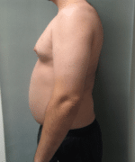 Severe Gynecomastia