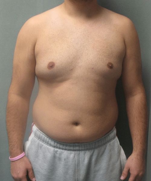 Severe Gynecomastia