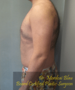 Severe Gynecomastia