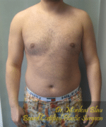 Severe Gynecomastia