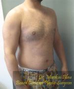 Severe Gynecomastia