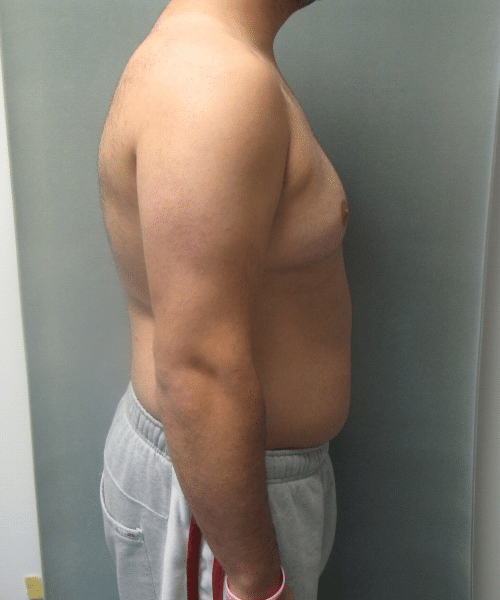 Severe Gynecomastia