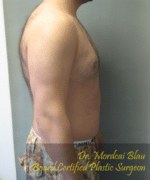 Severe Gynecomastia