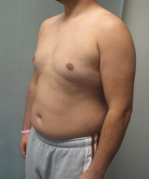 Severe Gynecomastia