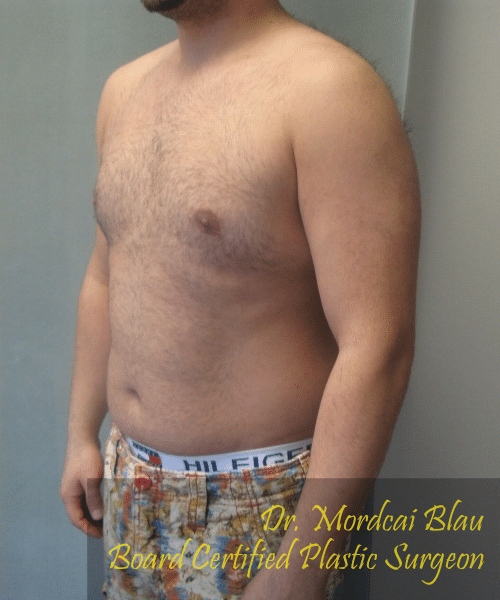 Severe Gynecomastia